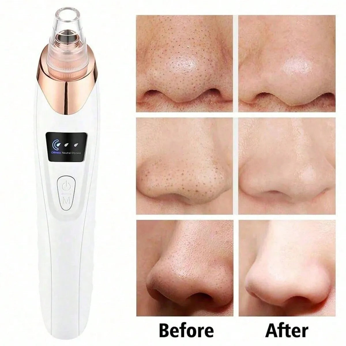 5-in-1 Rechargeable Derma Suction Blackhead Remover β Pore Vacuum Cleaner - Zafiee Mart