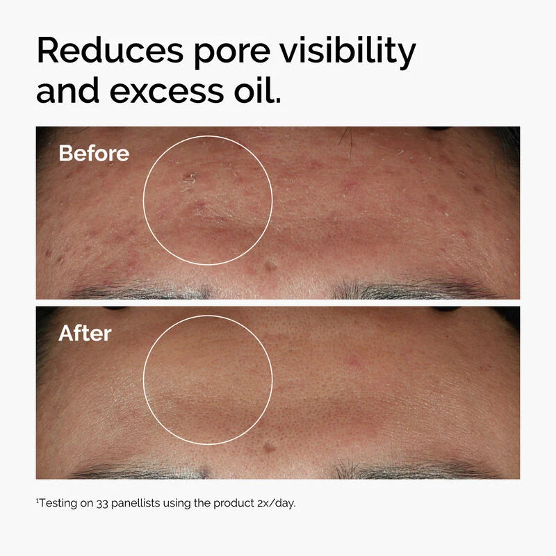 The Ordinary Niacinamide 10% + Zinc 1% Serum – For Clear, Glowing Skin (Clearance sale 55% off!!)) - Zafiee Mart