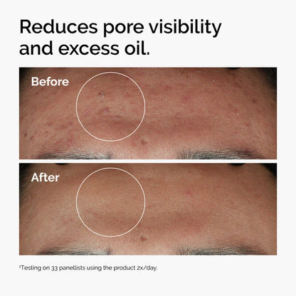 The Ordinary Niacinamide 10% + Zinc 1% Serum – For Clear, Glowing Skin (Clearance sale 55% off!!)) - Zafiee Mart